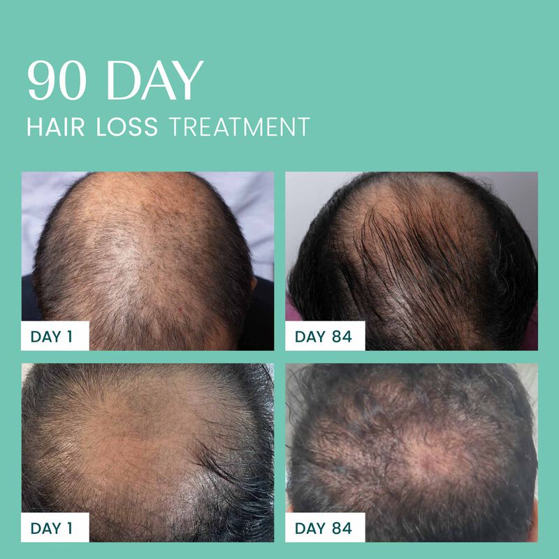 Densify 90-Day Hair Thickening & Anti-Hair Loss Ritual image number null